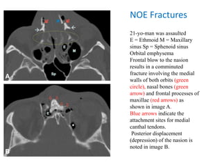 NOE Fractures
21-yo-man was assaulted
E = Ethmoid M = Maxillary
sinus Sp = Sphenoid sinus
Orbital emphysema
Frontal blow to the nasion
results in a comminuted
fracture involving the medial
walls of both orbits (green
circle), nasal bones (green
arrow) and frontal processes of
maxillae (red arrows) as
shown in image A.
Blue arrows indicate the
attachment sites for medial
canthal tendons.
Posterior displacement
(depression) of the nasion is
noted in image B.
 
