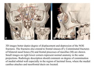 3D images better depict degree of displacement and depression of the NOE
fractures. The fractures also extend to frontal sinuses (F). Comminuted fractures
of bilateral nasal bones (N) and frontal processes of maxillae (M) are shown.
Small images on right lower corners represent normal anatomy in the same
projections. Radiologic description should comment on degree of comminution
of medial orbital wall especially in the region of lacrimal fossa, where the medial
canthus attaches and nasofrontal ducts are located.
 