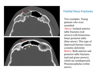 Frontal Sinus Fractures
Two examples. Young
patients who were
assaulted.
Above: Isolated anterior
table fractures (red
arrows) with hemosinus.
Intact posterior table
(blue arrow). This type of
depressed fracture causes
cosmetic deformity
Below: Both anterior and
posterior table fractures
(red and green arrows),
which are nondepressed.
Pneumocephalus (white
arrow)
 