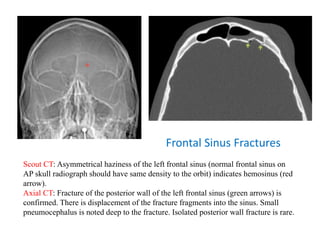 Frontal Sinus Fractures
Scout CT: Asymmetrical haziness of the left frontal sinus (normal frontal sinus on
AP skull radiograph should have same density to the orbit) indicates hemosinus (red
arrow).
Axial CT: Fracture of the posterior wall of the left frontal sinus (green arrows) is
confirmed. There is displacement of the fracture fragments into the sinus. Small
pneumocephalus is noted deep to the fracture. Isolated posterior wall fracture is rare.
 