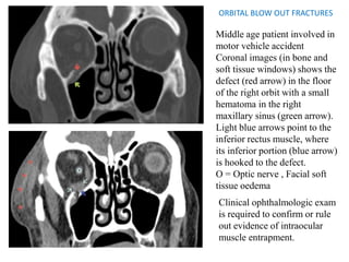 ORBITAL BLOW OUT FRACTURES
Middle age patient involved in
motor vehicle accident
Coronal images (in bone and
soft tissue windows) shows the
defect (red arrow) in the floor
of the right orbit with a small
hematoma in the right
maxillary sinus (green arrow).
Light blue arrows point to the
inferior rectus muscle, where
its inferior portion (blue arrow)
is hooked to the defect.
O = Optic nerve , Facial soft
tissue oedema
Clinical ophthalmologic exam
is required to confirm or rule
out evidence of intraocular
muscle entrapment.
 