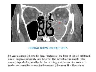 ORBITAL BLOW IN FRACTURES
80-year-old man fell onto his face. Fractures of the floor of the left orbit (red
arrow) displace superiorly into the orbit. The medial rectus muscle (blue
arrows) is pushed upward by the fracture fragment. Intraorbital volume is
further decreased by retroorbital hematoma (blue star). H = Hemosinus
 