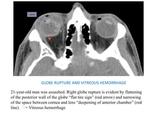 GLOBE RUPTURE AND VITREOUS HEMORRHAGE
21-year-old man was assaulted. Right globe rupture is evident by flattening
of the posterior wall of the globe “flat tire sign” (red arrow) and narrowing
of the space between cornea and lens “deepening of anterior chamber” (red
line). = Vitreous hemorrhage
 