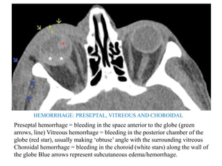 HEMORRHAGE: PRESEPTAL, VITREOUS AND CHOROIDAL
Preseptal hemorrhage = bleeding in the space anterior to the globe (green
arrows, line) Vitreous hemorrhage = bleeding in the posterior chamber of the
globe (red star), usually making ‘obtuse’ angle with the surrounding vitreous
Choroidal hemorrhage = bleeding in the choroid (white stars) along the wall of
the globe Blue arrows represent subcutaneous edema/hemorrhage.
 