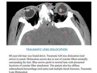 TRAUMATIC LENS DISLOCATION
60-year-old man was found down. Traumatic left lens dislocation (red
arrow) is noted. Dislocation occurs due to tear of zonular fibers normally
surrounding the lens. Blue arrows point to normal lens with presumed
locations of zonular fiber attachment. The patient also has diffuse
subarachnoid hemorrhage (red stars) and multiple facial fractures. Traumatic
Lens Dislocation
 