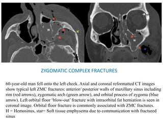 ZYGOMATIC COMPLEX FRACTURES
60-year-old man fell onto the left cheek. Axial and coronal reformatted CT images
show typical left ZMC fractures: anterior/ posterior walls of maxillary sinus including
rim (red arrows), zygomatic arch (green arrow), and orbital process of zygoma (blue
arrow). Left orbital floor ‘blow-out’fracture with intraorbital fat herniation is seen in
coronal image. Orbital floor fracture is commonly associated with ZMC fractures.
H = Hemosinus, star= Soft tissue emphysema due to communication with fractured
sinus
 