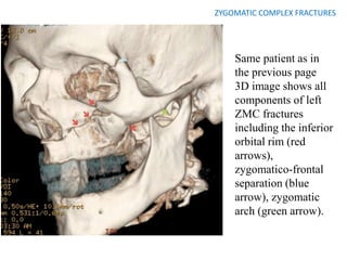 ZYGOMATIC COMPLEX FRACTURES
Same patient as in
the previous page
3D image shows all
components of left
ZMC fractures
including the inferior
orbital rim (red
arrows),
zygomatico-frontal
separation (blue
arrow), zygomatic
arch (green arrow).
 