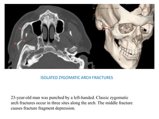 ISOLATED ZYGOMATIC ARCH FRACTURES
23-year-old man was punched by a left-handed. Classic zygomatic
arch fractures occur in three sites along the arch. The middle fracture
causes fracture fragment depression.
 