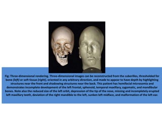 Fig: Three-dimensional rendering. Three-dimensional images can be reconstructed from the cuberilles, thresholded for
bone (left) or soft tissue (right), oriented in any arbitrary direction, and made to appear to have depth by highlighting
structures near the front and shadowing structures near the back. This patient has hemifacial microsomia and
demonstrates incomplete development of the left frontal, sphenoid, temporal maxillary, zygomatic, and mandibular
bones. Note also the reduced size of the left orbit, depression of the tip of the nose, missing and incompletely erupted
left maxillary teeth, deviation of the right mandible to the left, sunken left midface, and malformation of the left ear.
 