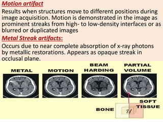 Motion artifact
Results when structures move to different positions during
image acquisition. Motion is demonstrated in the image as
prominent streaks from high- to low-density interfaces or as
blurred or duplicated images
Metal Streak artifacts:
Occurs due to near complete absorption of x-ray photons
by metallic restorations. Appears as opaque streak in
occlusal plane.
 