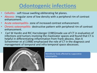 Odontogenic infections
• Cellulitis - soft tissue swelling obliterating fat planes.
• Abscess- irregular zone of low density with a peripheral rim of contrast
enhancement.
• Acute osteomyelitis- zone of increased contrast enhancement.
• Chronic osteomyelitis- destructive pattern with peripheral rim of contrast
enhancement.
• Carl W Hardin and RIC Harnsberger (1985)made use of CT in evaluation of
infections and tumors involving the masticator spaces and found that CT is
helpful in differentiating inflammation from frank abscess. Alan A
Schwimmer et al (1988) emphasized the role of CT in the diagnosis and
management of temporal and infra temporal space abscesses.
Mandibular body affected by suppurative
osteomyelitis.
 