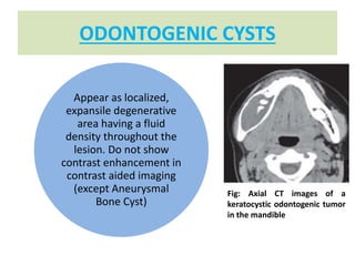 ODONTOGENIC CYSTS
Appear as localized,
expansile degenerative
area having a fluid
density throughout the
lesion. Do not show
contrast enhancement in
contrast aided imaging
(except Aneurysmal
Bone Cyst)
Fig: Axial CT images of a
keratocystic odontogenic tumor
in the mandible
 