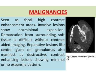 MALIGNANCIES
Seen as focal high contrast
enhancement areas. Invasive lesions
show no/minimal expansion.
Demarcation from surrounding soft
tissue is difficult without contrast
aided imaging. Reparative lesions like
central giant cell granulomas also
manifest as destructive, contrast
enhancing lesions showing minimal
or no expansile pattern.
Fig: Osteosarcoma of jaw in
CT
 