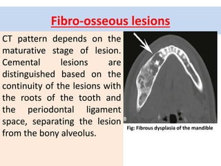 Fibro-osseous lesions
CT pattern depends on the
maturative stage of lesion.
Cemental lesions are
distinguished based on the
continuity of the lesions with
the roots of the tooth and
the periodontal ligament
space, separating the lesion
from the bony alveolus.
Fig: Fibrous dysplasia of the mandible
 