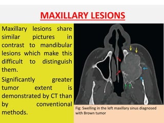 MAXILLARY LESIONS
Maxillary lesions share
similar pictures in
contrast to mandibular
lesions which make this
difficult to distinguish
them.
Significantly greater
tumor extent is
demonstrated by CT than
by conventional
methods.
Fig: Swelling in the left maxillary sinus diagnosed
with Brown tumor
 