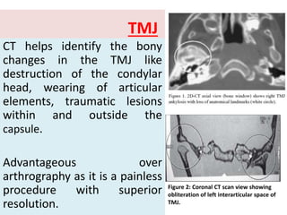 TMJ
CT helps identify the bony
changes in the TMJ like
destruction of the condylar
head, wearing of articular
elements, traumatic lesions
within and outside the
capsule.
Advantageous over
arthrography as it is a painless
procedure with superior
resolution.
Figure 2: Coronal CT scan view showing
obliteration of left interarticular space of
TMJ.
 