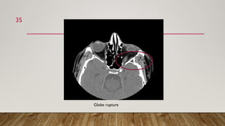 Globe Rupture Memory Note Ct scan in ophthalmology.pptx very important | PPTX