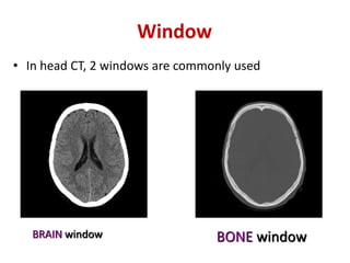 Ct scan brain lecture by rashimul haque rimon | PPTX