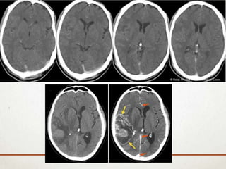 Ct Scan Brainline BRAIN CT SCAN | PPTX