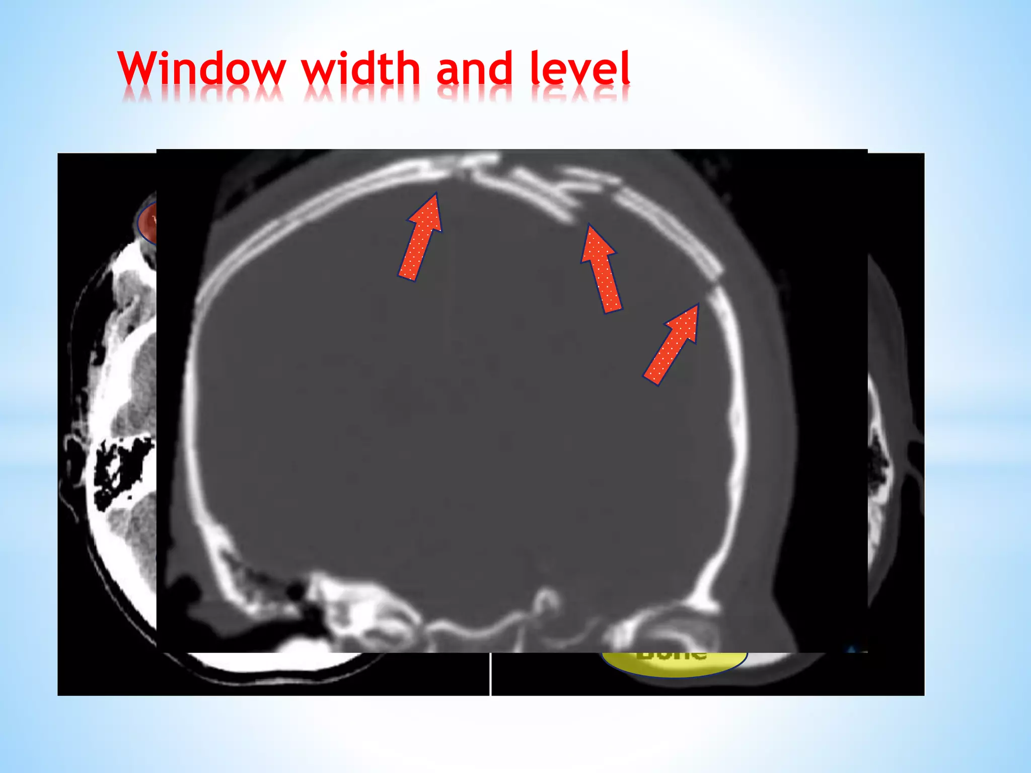 Window width and level
 