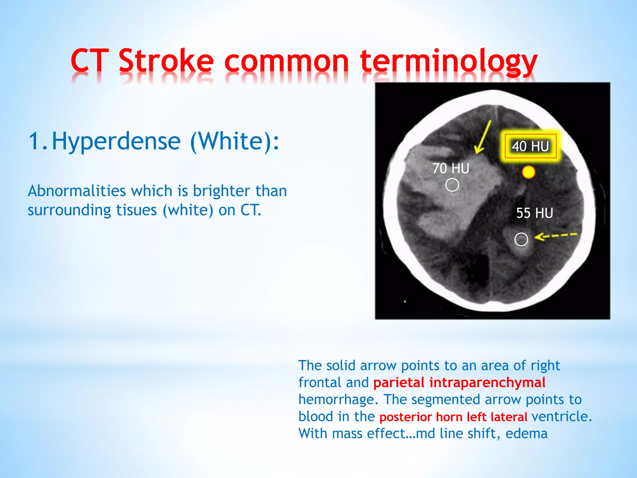 CT Stroke common terminology
1.Hyperdense (White):
Abnormalities which is brighter than
surrounding tisues (white) on CT.
The solid arrow points to an area of right
frontal and parietal intraparenchymal
hemorrhage. The segmented arrow points to
blood in the posterior horn left lateral ventricle.
With mass effect…md line shift, edema
55 HU
40 HU
70 HU
 