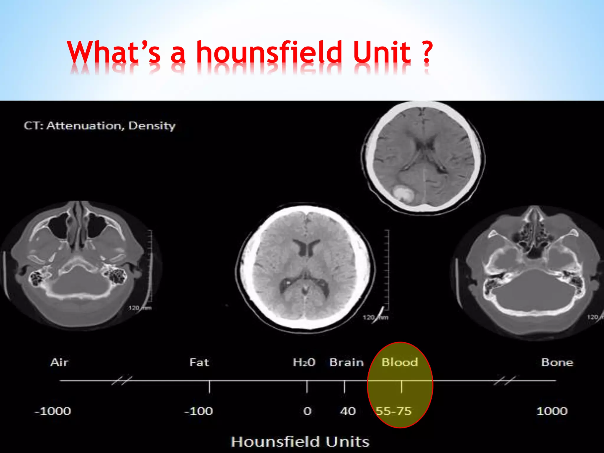 What’s a hounsfield Unit ?
 