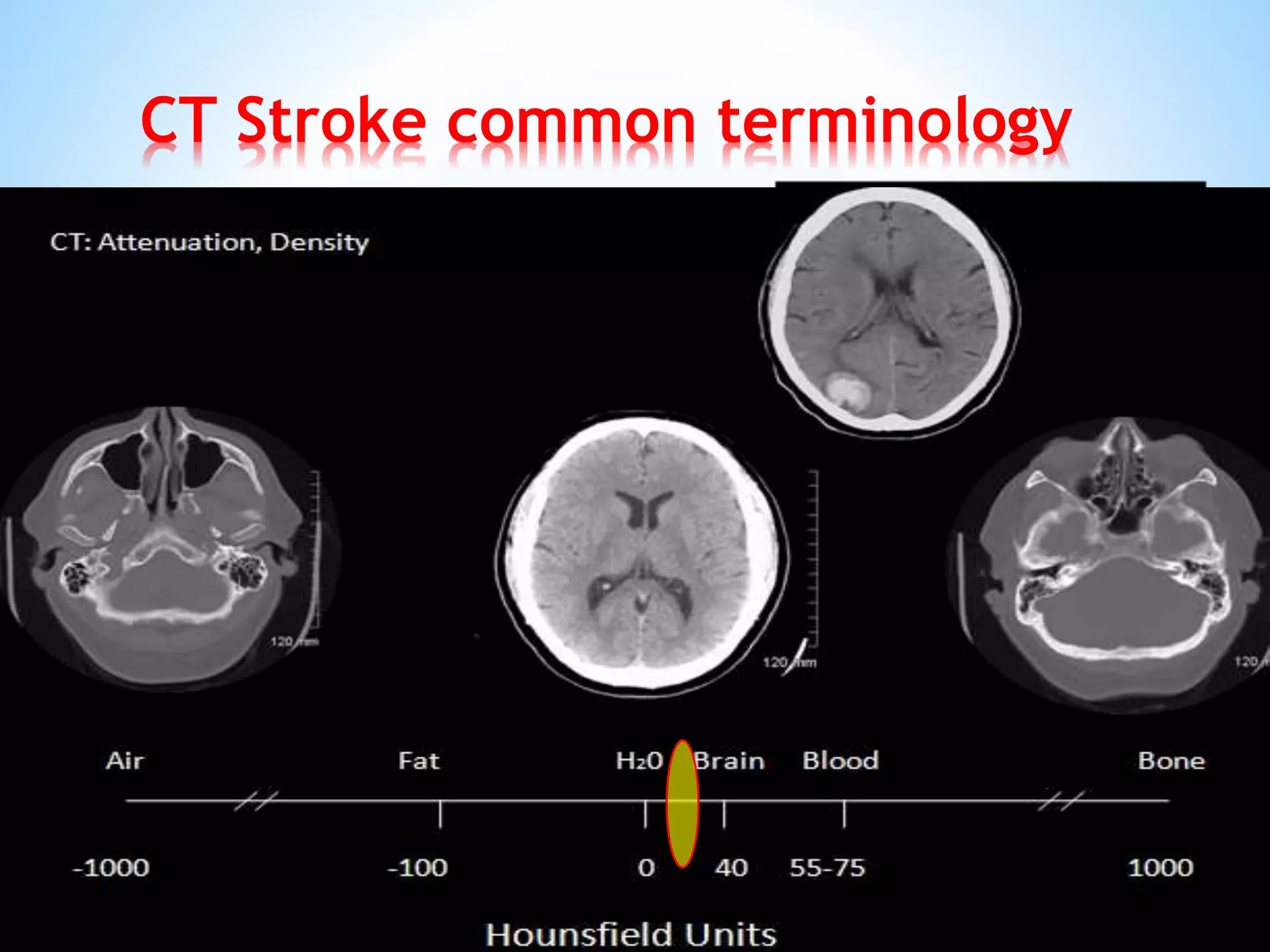 CT Stroke common terminology
2. Isodense (same density):
Abnormalities which have relatively same
density with the reference structures.
The solid arrow points to an Isodense area
in supracellar cistern, a normal structure,
which is filled with CSF. The dashed arrow
points to an area that is isodense to CSF.
This is cisterna magna, a normal structural
variant.
14 HU
12 HU
 