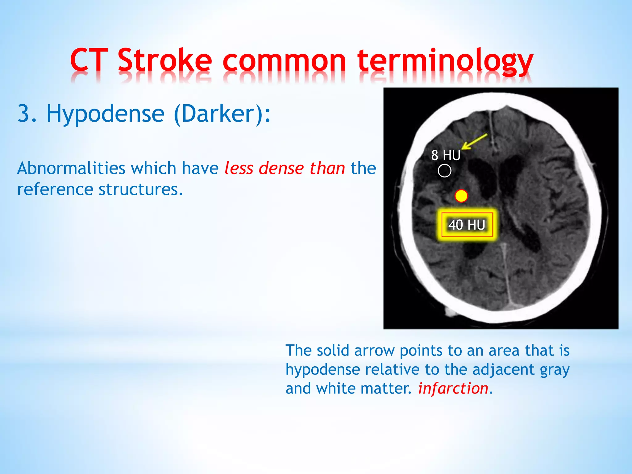 CT Stroke common terminology
3. Hypodense (Darker):
Abnormalities which have less dense than the
reference structures.
The solid arrow points to an area that is
hypodense relative to the adjacent gray
and white matter. infarction.
8 HU
40 HU
 