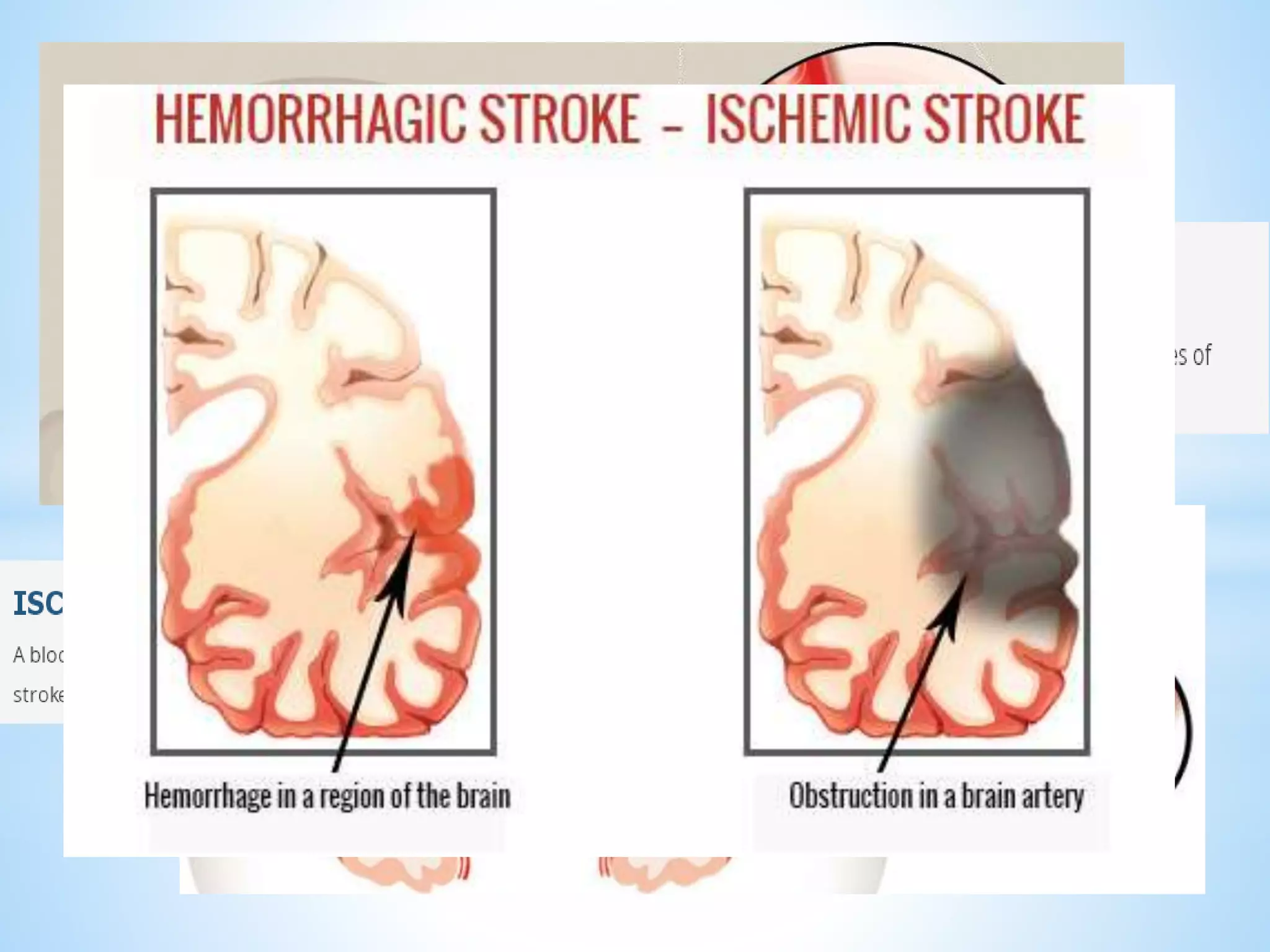  stroke patients.
 
