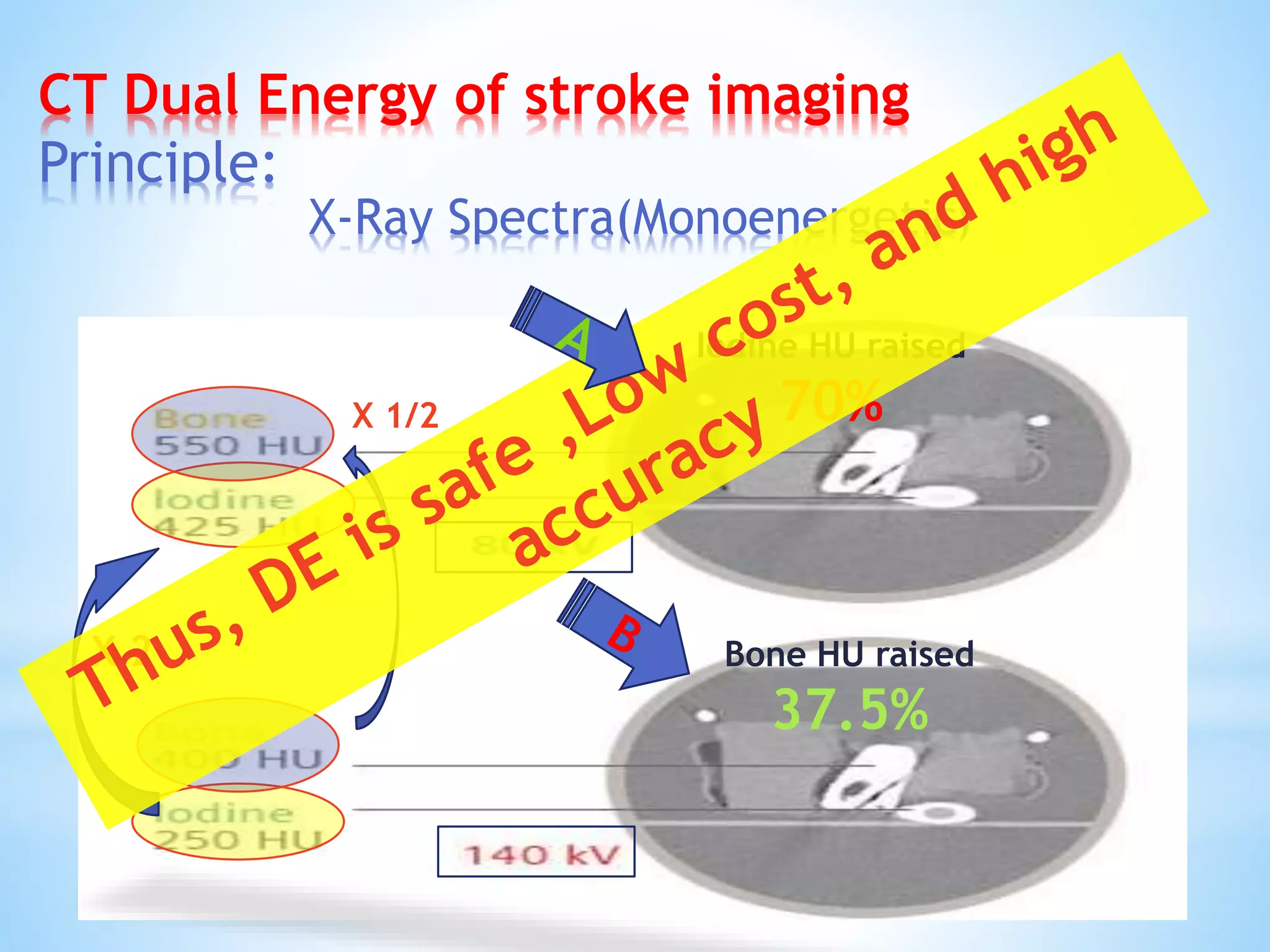 CT Dual Energy of stroke imaging
Principle:
Iodine HU raised
70%
Bone HU raised
37.5%
X-Ray Spectra(Monoenergetic)
X 2
X 1/2
 