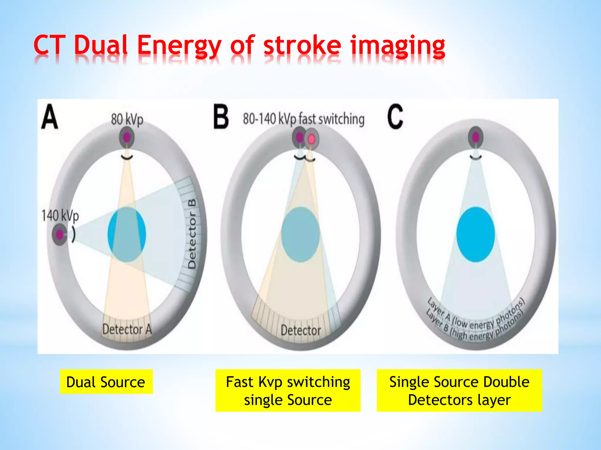 CT Dual Energy of stroke imaging
Dual Source Fast Kvp switching
single Source
Single Source Double
Detectors layer
 