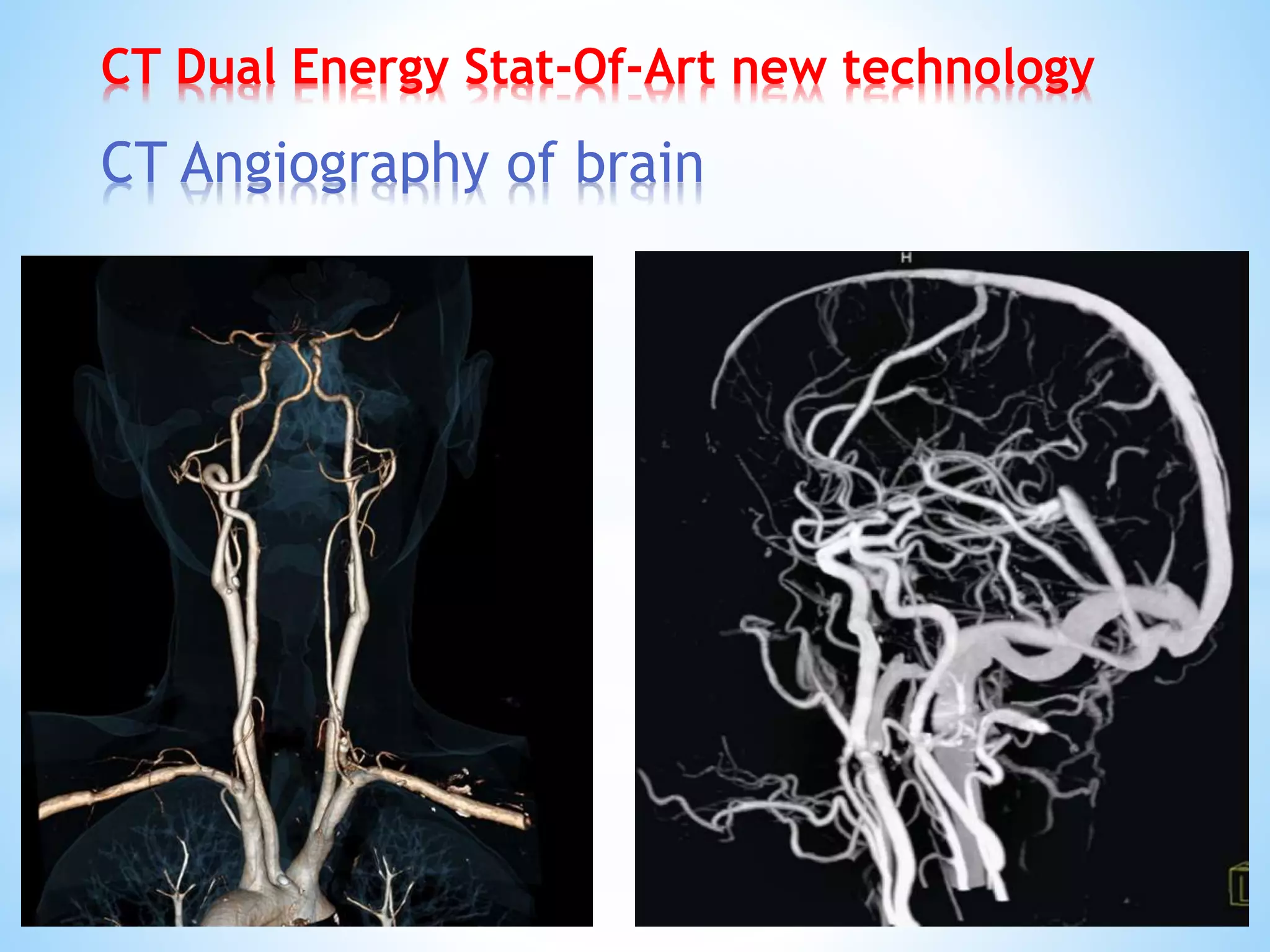 CT Dual Energy Stat-Of-Art new technology
CT Angiography of brain
 