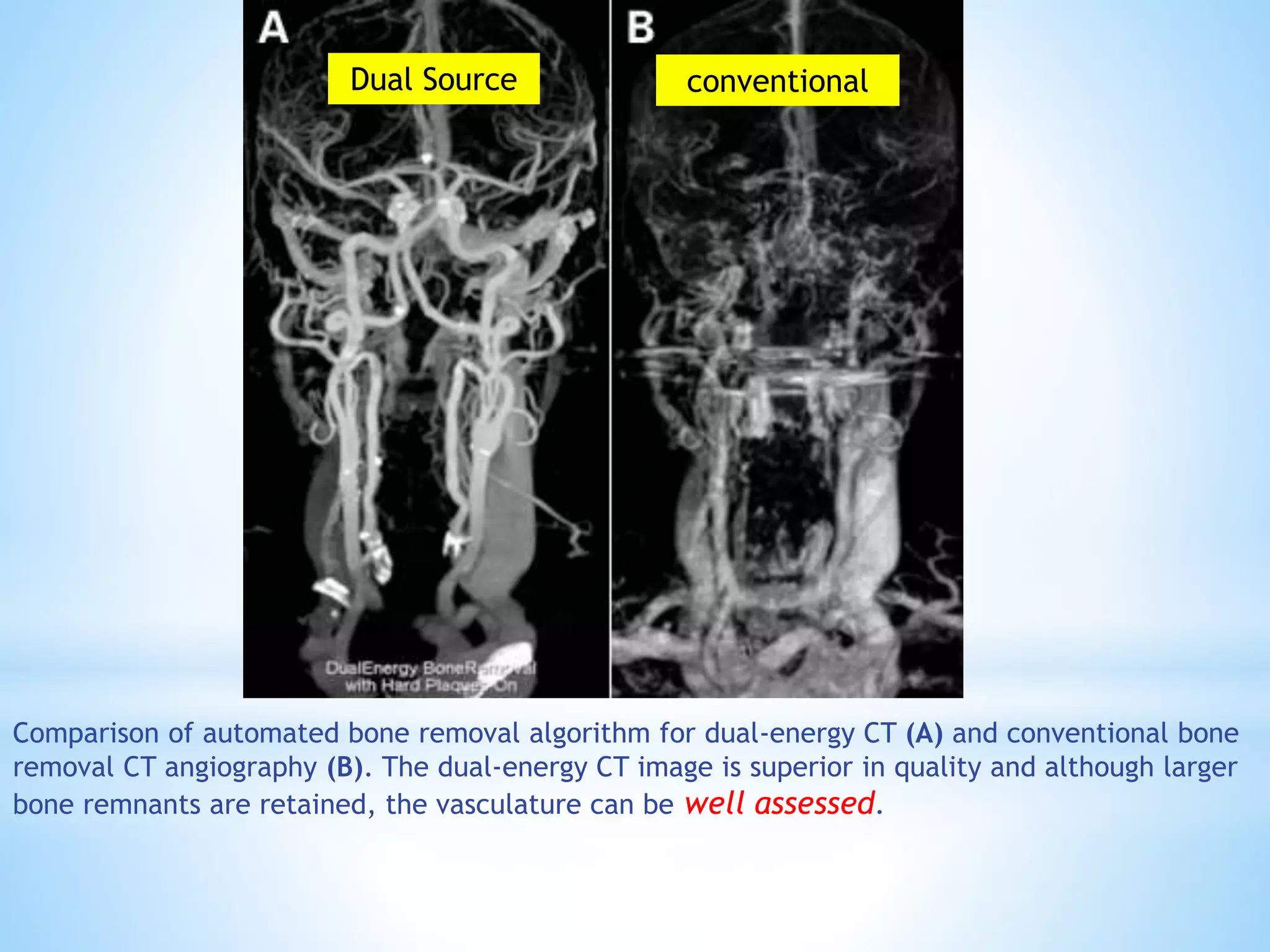Comparison of automated bone removal algorithm for dual-energy CT (A) and conventional bone
removal CT angiography (B). The dual-energy CT image is superior in quality and although larger
bone remnants are retained, the vasculature can be well assessed.
Dual Source conventional
 