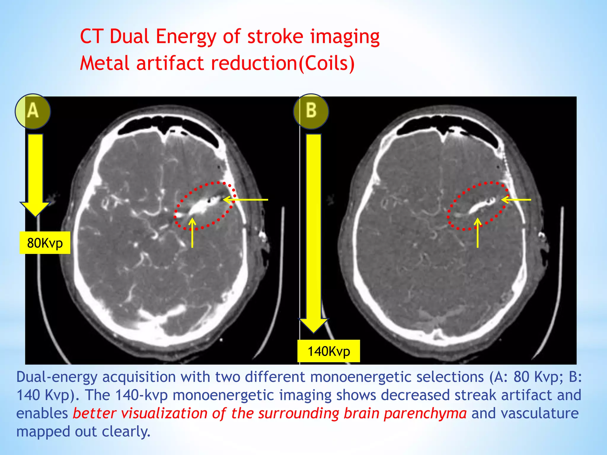 Dual-energy acquisition with two different monoenergetic selections (A: 80 Kvp; B:
140 Kvp). The 140-kvp monoenergetic imaging shows decreased streak artifact and
enables better visualization of the surrounding brain parenchyma and vasculature
mapped out clearly.
CT Dual Energy of stroke imaging
Metal artifact reduction(Coils)
80Kvp
140Kvp
 