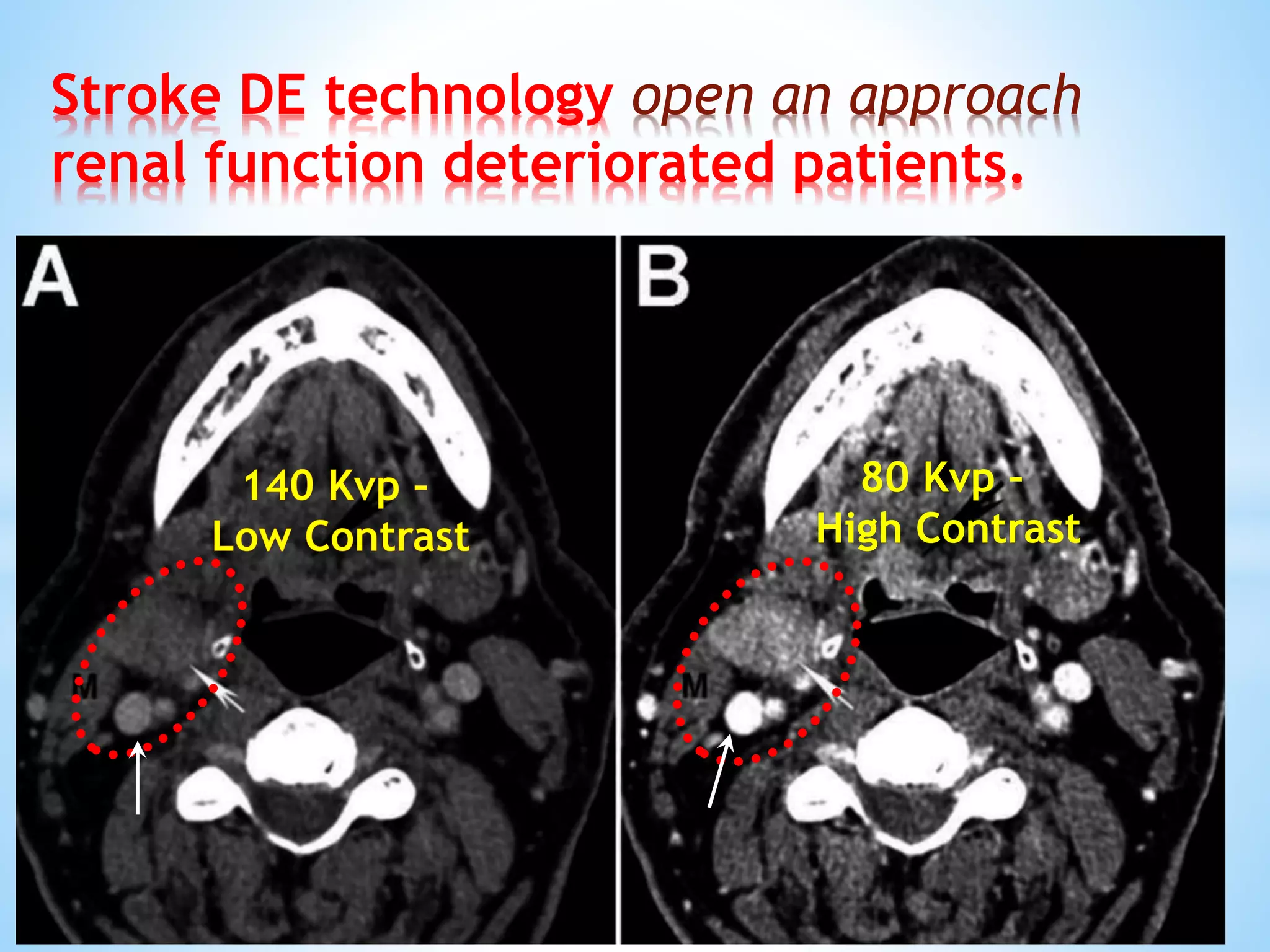 Stroke DE technology open an approach
renal function deteriorated patients.
80 Kvp –
High Contrast
 