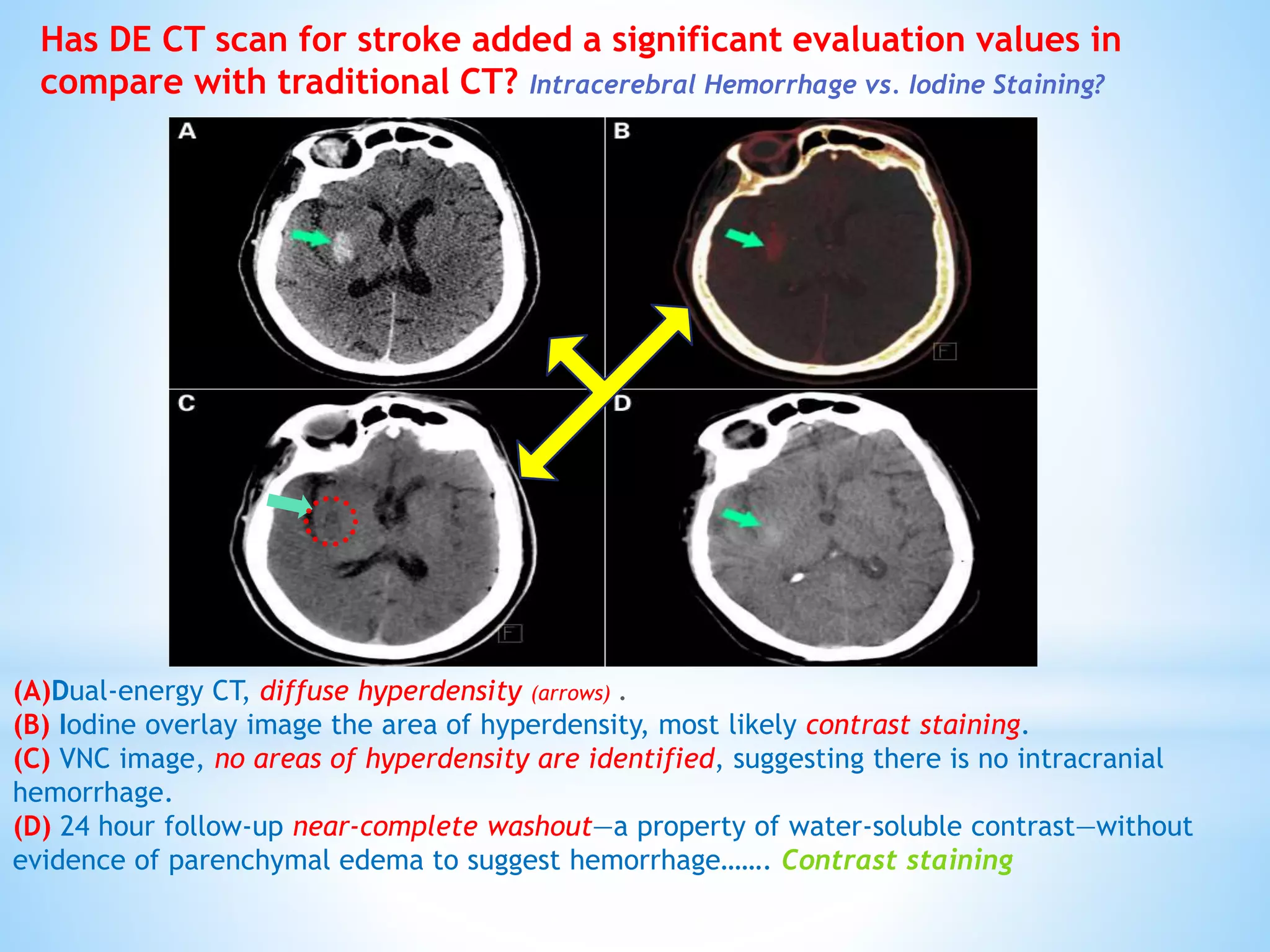 (A)Dual-energy CT, diffuse hyperdensity (arrows)
(B) Iodine overlay image the area of hyperdensity, most likely contrast staining.
(C) VNC image, no areas of hyperdensity are identified, suggesting there is no intracranial
hemorrhage.
(D) 24 hour follow-up near-complete washout—a property of water-soluble contrast—without
evidence of parenchymal edema to suggest hemorrhage……. Contrast staining
Has DE CT scan for stroke added a significant evaluation values in
compare with traditional CT? Intracerebral Hemorrhage vs. Iodine Staining?
 