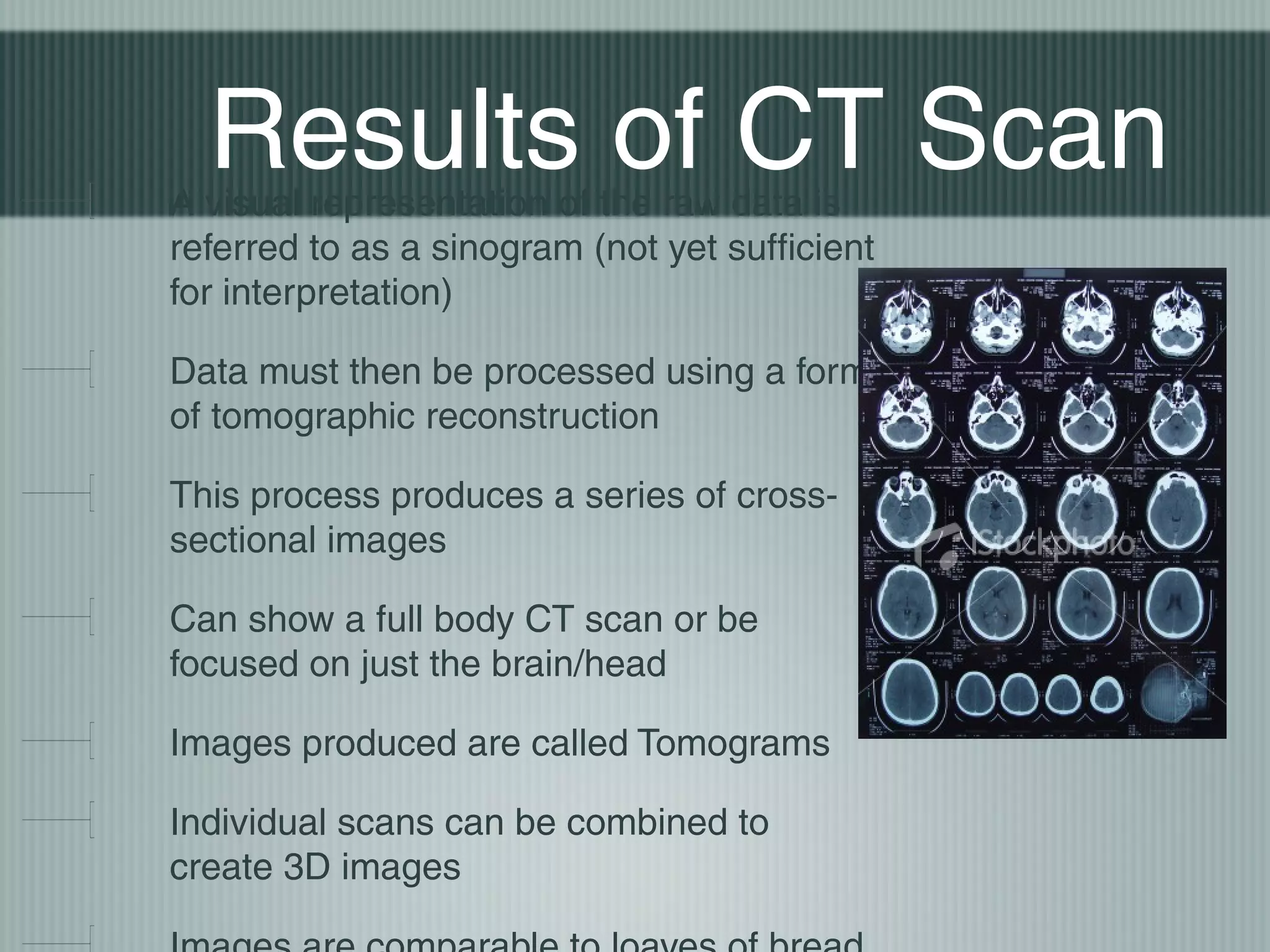 Results of CT Scan

A visual representation of the raw data is
referred to as a sinogram (not yet sufficient
for interpretation)
Data must then be processed using a form
of tomographic reconstruction
This process produces a series of crosssectional images
Can show a full body CT scan or be
focused on just the brain/head
Images produced are called Tomograms
Individual scans can be combined to
create 3D images

 