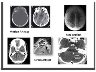 Computed Tomography (CT) scan is an advanced imaging technique that ...