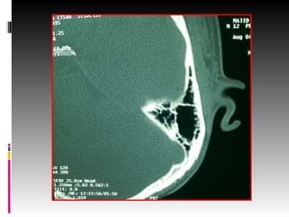 Temporal Scan ct scan temporal-1.pptxhhghjjjnbbbbnjnbbjj | PPTX