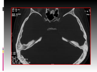 Temporal Scan ct scan temporal-1.pptxhhghjjjnbbbbnjnbbjj | PPTX