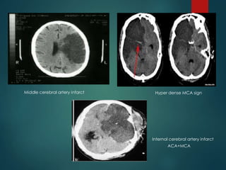 CT imaging of Brain in Clinical Practice by Dr. Vaibhav Yawalkar | PPTX