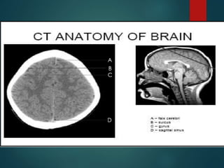 Blood
 Blood is the most common hyperdense
abnormality found on a brain CT scan. So if a
hyperdense appearance is not in ...