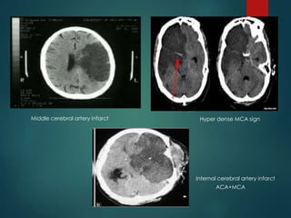 CT appearance of increased intracranial pressure:
A: normal intracranial pressure
B: elevated intracranial pressure.
A B
 