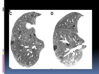 CT SIGNS IN CHESt for pulmonary medicine | PPTX