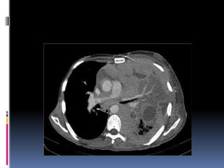 CT SIGNS IN CHESt for pulmonary medicine | PPTX