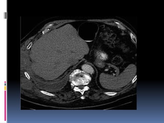 CT SIGNS IN CHESt for pulmonary medicine | PPTX