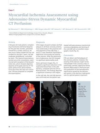 Clinical Results Cardiovascular 
Case 1 
Myocardial Ischemia Assessment using 
Adenosine-Stress Dynamic Myocardial 
CT Perfusion 
By Dikraniant T.¹, MD; Ghijselings L.², MD; Vargas Lobos M.², MT; Genard L.², MT; Derauw O.², MT; Deconinck D.², MT 
1 Internal Medicine Department-Cardiology, Europa Clinics, Brussels, Belgium 
2 Medical Imaging Department, Europa Clinics, Brussels, Belgium 
48 SOMATOM Sessions | December 2013 | www.siemens.com/SOMATOM-Sessions 
treated with percutaneous transluminal 
coronary angioplasty and stenting of 
the mid LAD with an excellent angio-graphic 
result (Fig. 4). 
Comments 
CTA can detect calcified plaques of 
the coronary arteries; however, the 
severity of the stenosis might not be 
interpretable if the coronary artery is 
extensively calcified. Adenosine-Stress 
Dynamic Myocardial CT Perfusion per-mits 
evaluation of the hemodynamic 
significance caused by the stenosis, 
and assists in the decision-making pro-cess 
for optimal patient treatment. 
Diagnosis 
CTA images showed multiple calcified 
plaques in all three coronary arteries, 
most extensively in the proximal and 
mid segments of the LAD (Figs. 1 
and 2). It was therefore impossible to 
determine conclusively the severity 
of the stenosis. After the administra-tion 
of adenosine, the ECG showed 
no significant abnormality at all. 
Stress perfusion images (Fig. 3) 
showed a significant reduction in the 
myocardial blood flow in the LAD 
territory, compared with the CFX or 
RCA territories. The findings depicted 
a significant ischemia in this region. 
In the cath lab, the mid LAD stenosis 
was confirmed and the patient was 
History 
A 66-year-old male patient, complain-ing 
of evolutive exertional dyspnea 
for the past few months, presented 
himself for a cardiac check-up. He 
was once a heavy smoker but has not 
smoked for the past 7 years. He had 
moderate dyslipidemia, controlled 
by statin. The classical examinations, 
carried out at the consultation, were 
normal with exception of the bicycle-stress 
test, which showed objective 
dyspnea at the peak exercise of 110 
watts without ECG abnormalities. 
Since the stress test was non-conclu-sive, 
CTA was proposed to complete 
the examinations. 
1 
VRT (Fig. 1A) 
and curved 
MPR (Fig. 1B) 
images demon-strate 
the 
extensively 
calcified LAD. 
1A 1B 
 