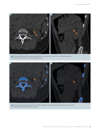 1A 1B 
Oblique MPR images show two tiny renal calculi on the left. One is about 3 mm in diameter (arrows), 
and the other one is even smaller (dashed arrows). 
SOMATOM Sessions | December 2013 | www.siemens.com/SOMATOM-Sessions 63 
1 
2A 2B 
DE images reveal two renal calculi on the left. The bigger one (arrows) exhibits densities of up to 515 HU, 
and both were classified as non-uric acid. 
2 
Urology Clinical Results 
 
