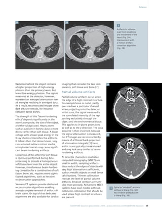2 
SOMATOM Sessions | December 2013 | www.siemens.com/SOMATOM-Sessions 69 
Radiation behind the object contains 
a higher proportion of high-energy 
photons than the primary beam, but 
fewer low-energy photons. The signals 
measured at the detector, however, 
represent an averaged attenuation over 
all energies resulting in averaged data. 
As a result, reconstructed images show 
dark areas or streaks, for instance 
between dense bones. 
The strength of this “beam-hardening 
effect” depends significantly on the 
atomic composite, the size of the object, 
and the voltage used. Heavy atoms 
such as calcium in bones cause a more 
distinct effect than soft tissue. A lower 
voltage with a lower peak energy in the 
X-ray photons intensifies the artifacts. 
It follows then that dense bones, very 
concentrated iodine contrast media, 
or implanted metals may cause signifi-cant 
beam-hardening artifacts. 
Correction of this effect for soft tissue 
is routinely performed during data 
processing to provide a homogeneous 
soft tissue level over the entire object. 
However, simultaneous beam-harden-ing 
correction for a combination of soft 
tissue, bone, etc. requires more sophis-ticated 
algorithms, such as iterative 
reconstruction approaches. 
Siemens CT systems provide dedicated 
reconstruction algorithms enabling 
almost complete removal of artifacts in 
brain scans. On top of that dedicated 
algorithms are also available for cardiac 
imaging that consider the two com-ponents, 
soft ­tissue 
and bone.[2] 
Partial volume artifacts 
Partial volume artifacts occur when 
the edge of a high contrast structure, 
for example bone or metal, partly 
overshadows a particular channel 
when projecting onto the detector. 
In this case, the signal measured is 
the cumulated intensity of the rays 
passing exclusively through the 
object and the environmental tissue. 
This applies to in-plane projections 
as well as to the z-direction. The data 
acquired is then incorrect, because 
the signal attenuation is measured, 
but CT images are reconstructed by 
means of a filtered back-projection 
of attenuation integrals.[1] Here, 
artifacts are typically streak-shaped 
and may look very similar to beam-hardening 
artifacts. 
As detector channels in multislice 
computed tomography (MSCT) are 
small in width, sampling artifacts 
occur only at the edges of objects with 
very high attenuation coefficients, 
such as metallic objects or small dense 
calcifications. Thinner collimation 
reduces the level of partial volume 
artifacts, because contours are sam-pled 
more precisely. All Siemens MSCT 
systems have scan modes with sub-millimeter 
collimation that should be 
used where high contrast structures 
are present. 
Artifacts in a thorax 
scan from breathing 
and movement of the 
heart (Fig. 2A). 
Improvement with 
a motion artifact 
correction algorithm 
(Fig. 2B). 
Spiral or “windmill” artifacts 
without z-Sharp (Fig. 3A). 
No windmill artifacts with 
z-Sharp (Fig. 3B). 
3 
2A 
3A 
3B 
2B 
Science 
 