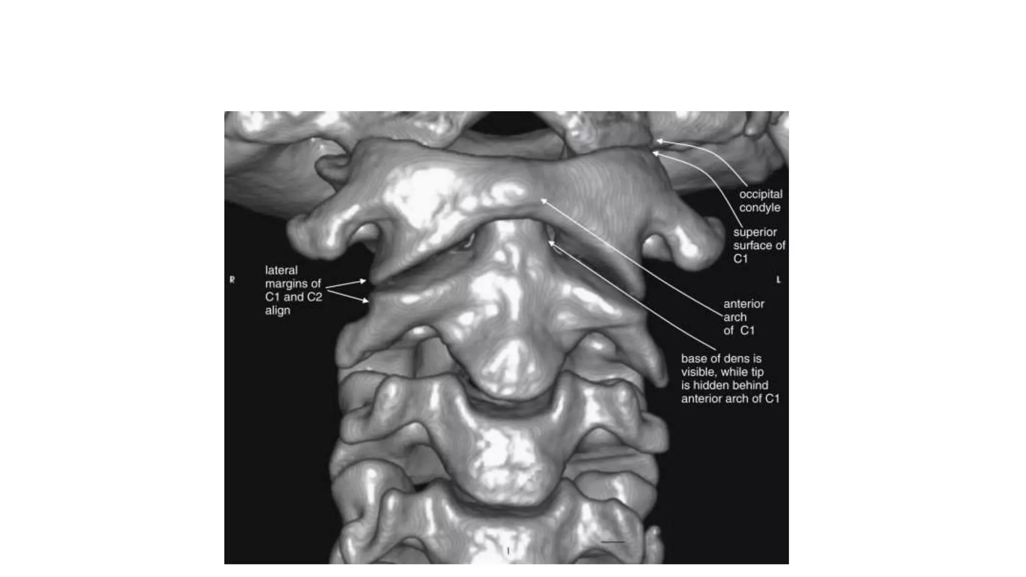 This three-dimensional reconstruction from computed tomography (CT) axial images focuses on the occipital–
cervical junction and the C1-2 (atlantoaxial) junction
 